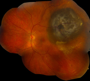 A cancerous melanoma tumor -dark area, upper right- is seen below the retina